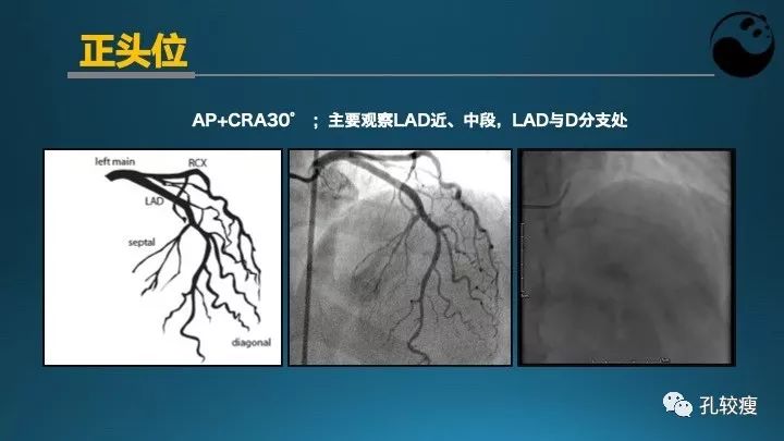 步步为营掌握冠状动脉造影【一】：解剖-体位-安全法则