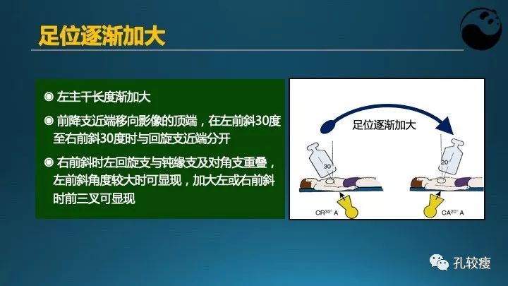 步步为营掌握冠状动脉造影【一】：解剖-体位-安全法则