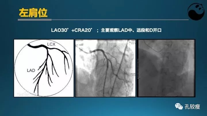 步步为营掌握冠状动脉造影【一】：解剖-体位-安全法则