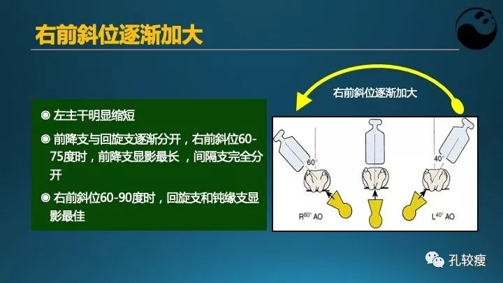 步步为营掌握冠状动脉造影【一】：解剖-体位-安全法则