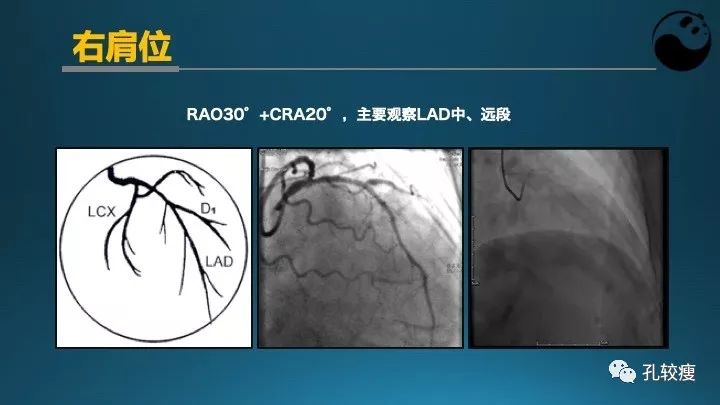 步步为营掌握冠状动脉造影【一】：解剖-体位-安全法则