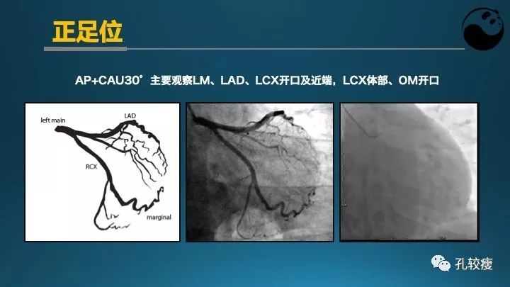 步步为营掌握冠状动脉造影【一】：解剖-体位-安全法则