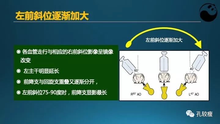 步步为营掌握冠状动脉造影【一】：解剖-体位-安全法则