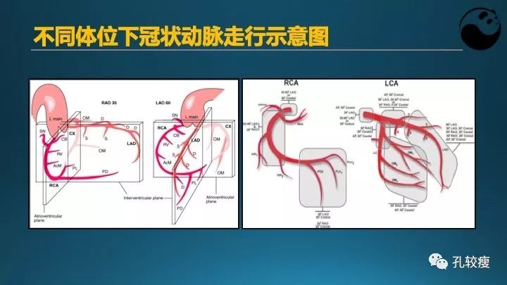 步步为营掌握冠状动脉造影【一】：解剖-体位-安全法则