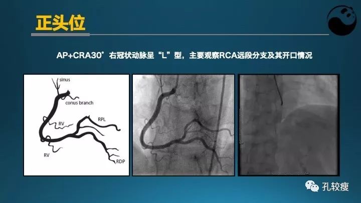 步步为营掌握冠状动脉造影【一】：解剖-体位-安全法则