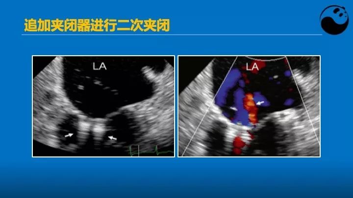 如何使用超声心动图引导瓣膜病介入治疗？