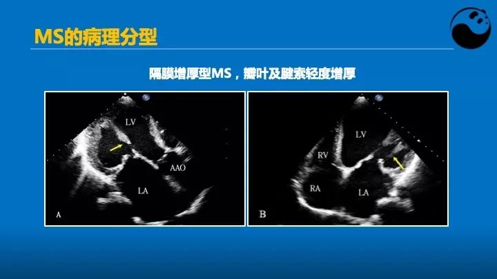 如何使用超声心动图引导瓣膜病介入治疗？