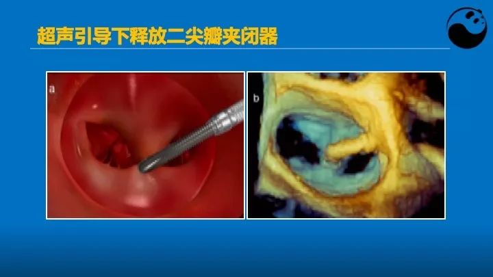 如何使用超声心动图引导瓣膜病介入治疗？