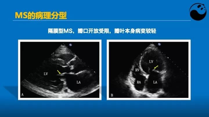 如何使用超声心动图引导瓣膜病介入治疗？