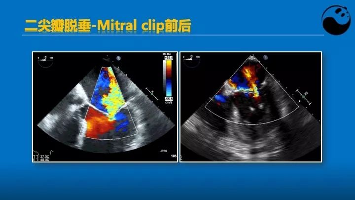 如何使用超声心动图引导瓣膜病介入治疗？