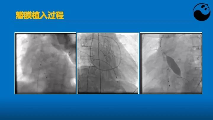 如何使用超声心动图引导瓣膜病介入治疗？