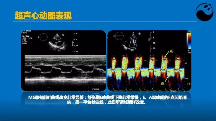 如何使用超声心动图引导瓣膜病介入治疗？