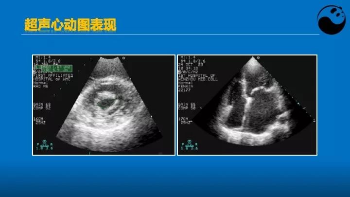 如何使用超声心动图引导瓣膜病介入治疗？