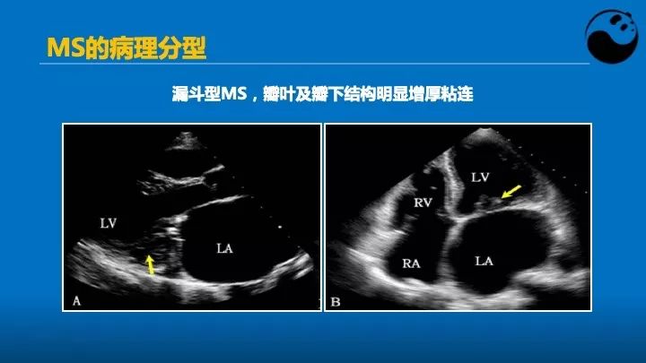 如何使用超声心动图引导瓣膜病介入治疗？