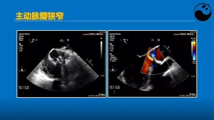 如何使用超声心动图引导瓣膜病介入治疗？