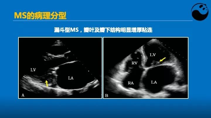 如何使用超声心动图引导瓣膜病介入治疗？