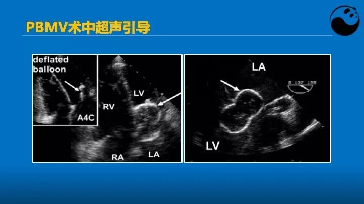 如何使用超声心动图引导瓣膜病介入治疗？