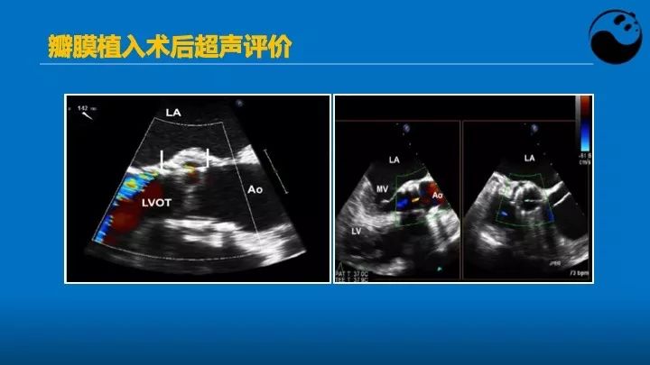 如何使用超声心动图引导瓣膜病介入治疗？