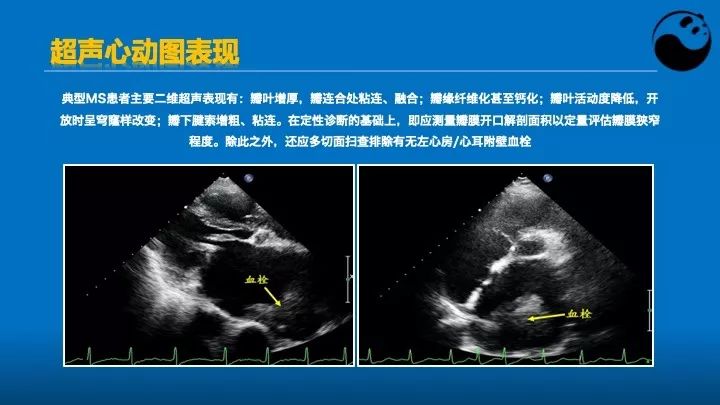 如何使用超声心动图引导瓣膜病介入治疗？