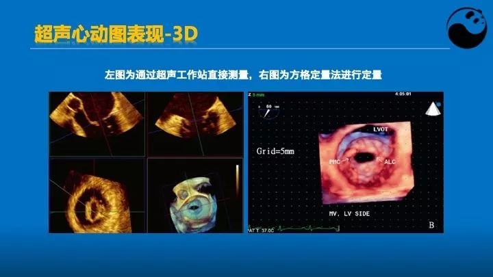 如何使用超声心动图引导瓣膜病介入治疗？