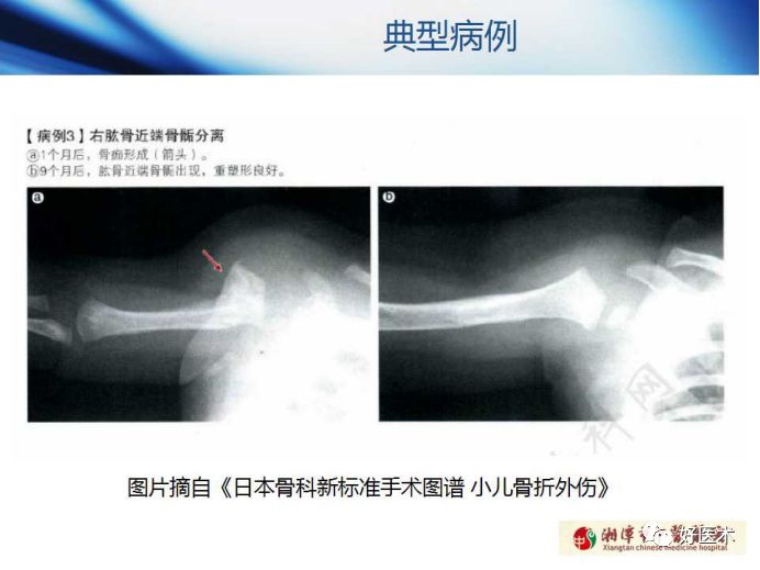 关于骨折塑形，这篇文章讲得太全面了！