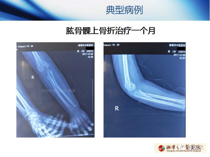 关于骨折塑形，这篇文章讲得太全面了！