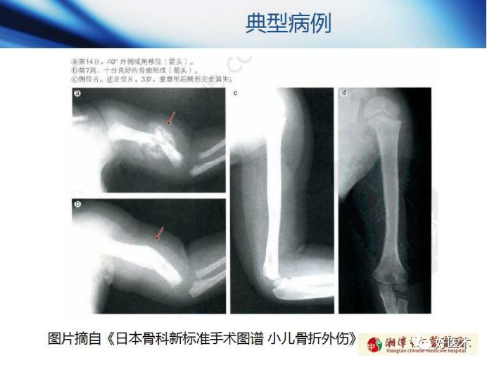 关于骨折塑形，这篇文章讲得太全面了！