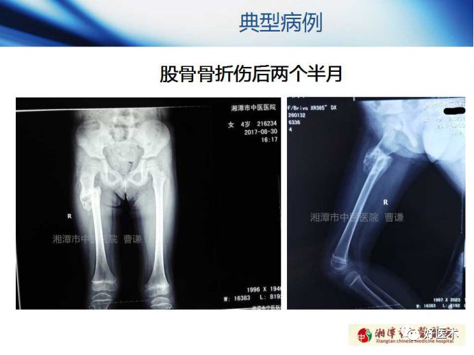 关于骨折塑形，这篇文章讲得太全面了！