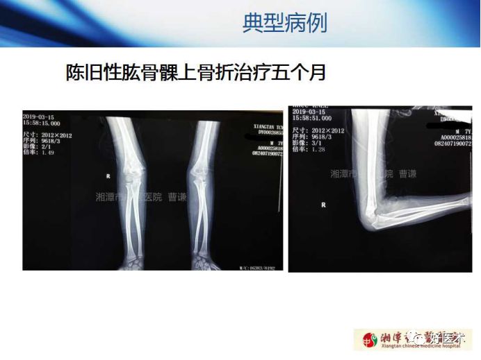 关于骨折塑形，这篇文章讲得太全面了！