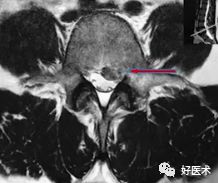 椎间孔镜治疗腰椎间盘突出症，技巧详解！