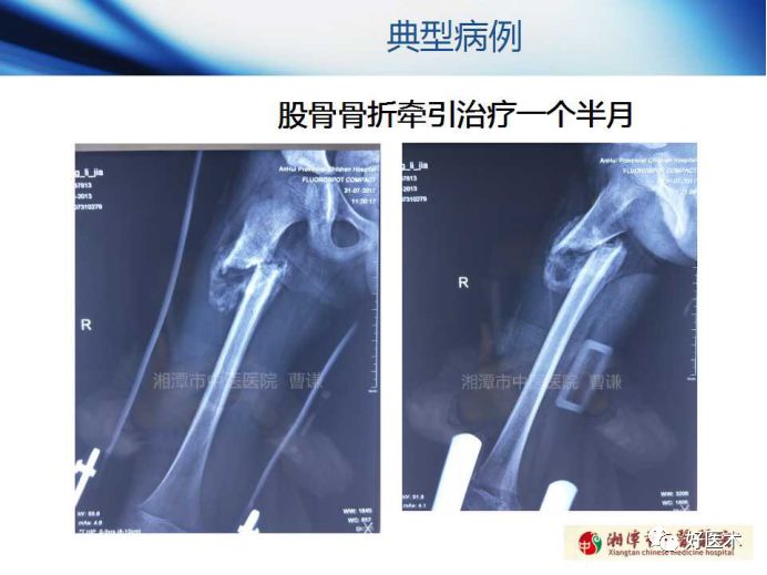 关于骨折塑形，这篇文章讲得太全面了！