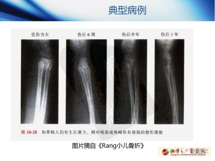 关于骨折塑形，这篇文章讲得太全面了！