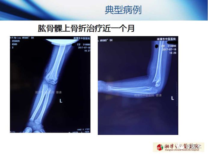 关于骨折塑形，这篇文章讲得太全面了！