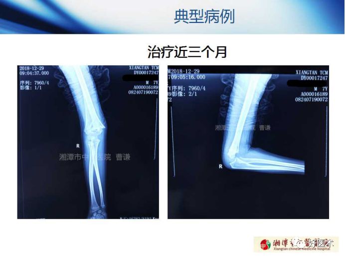 关于骨折塑形，这篇文章讲得太全面了！