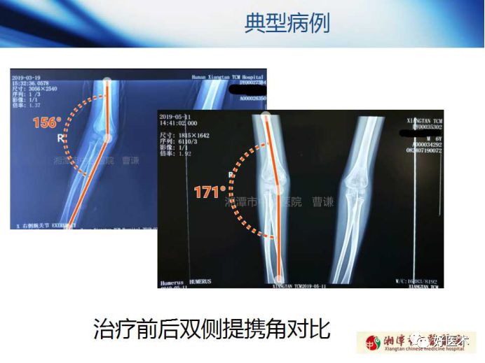 关于骨折塑形，这篇文章讲得太全面了！