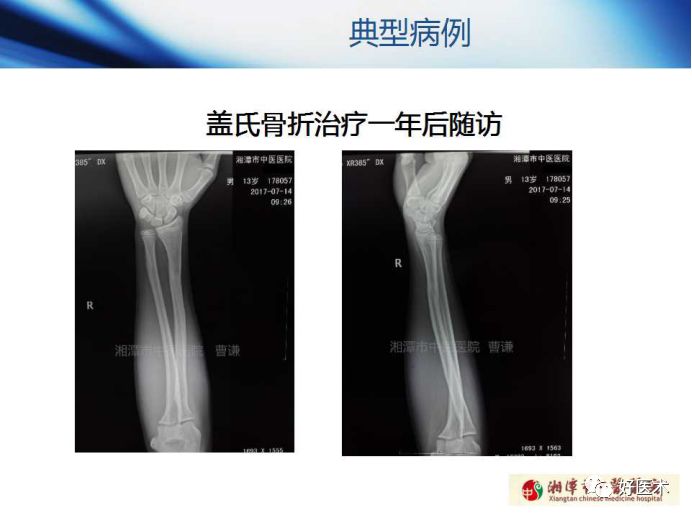 关于骨折塑形，这篇文章讲得太全面了！