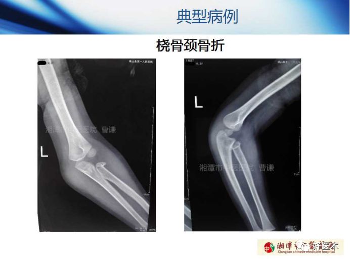 关于骨折塑形，这篇文章讲得太全面了！