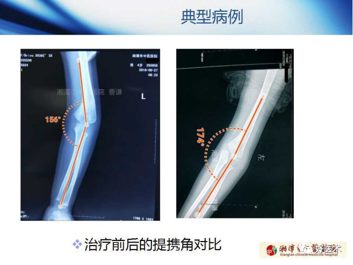 关于骨折塑形，这篇文章讲得太全面了！