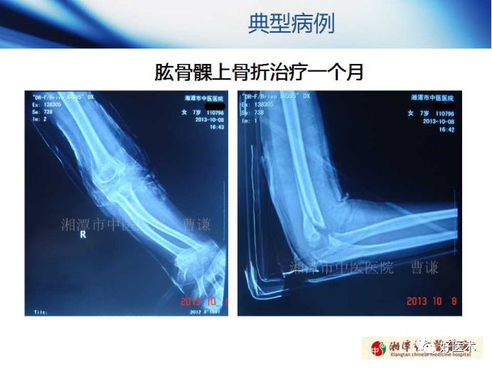 关于骨折塑形，这篇文章讲得太全面了！