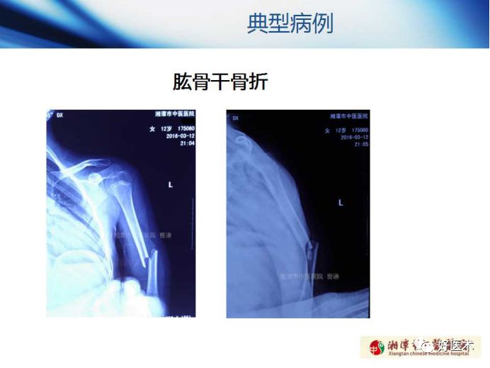 关于骨折塑形，这篇文章讲得太全面了！