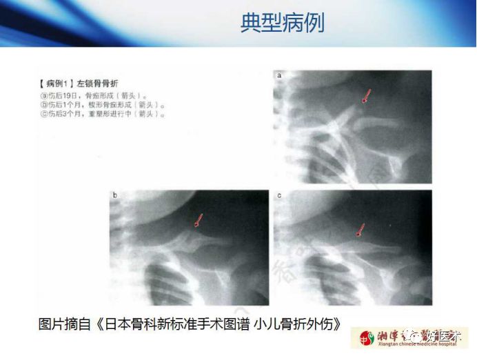 关于骨折塑形，这篇文章讲得太全面了！