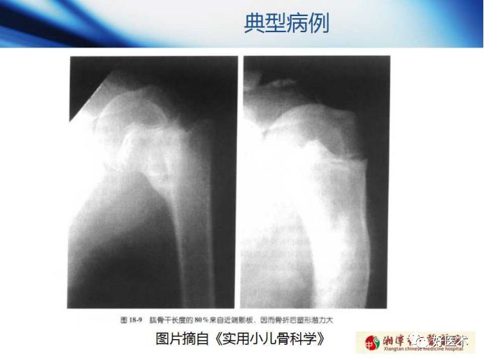 关于骨折塑形，这篇文章讲得太全面了！