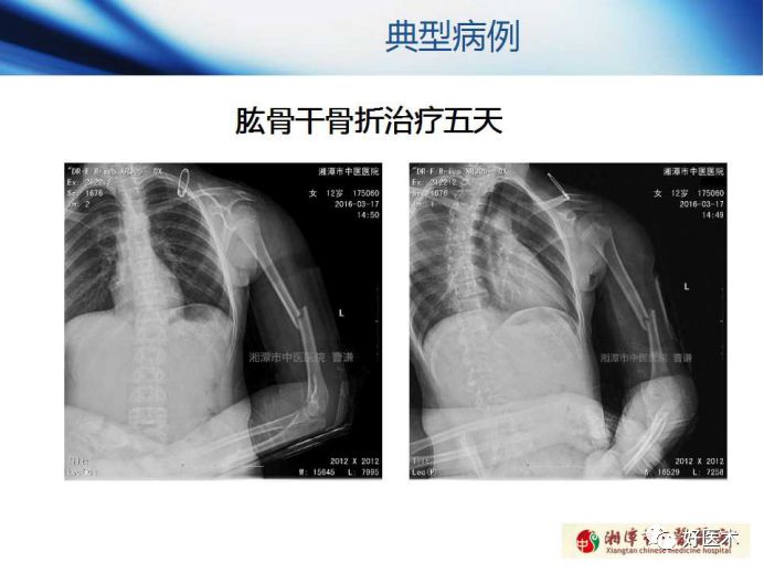 关于骨折塑形，这篇文章讲得太全面了！