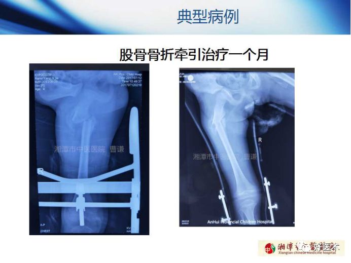 关于骨折塑形，这篇文章讲得太全面了！