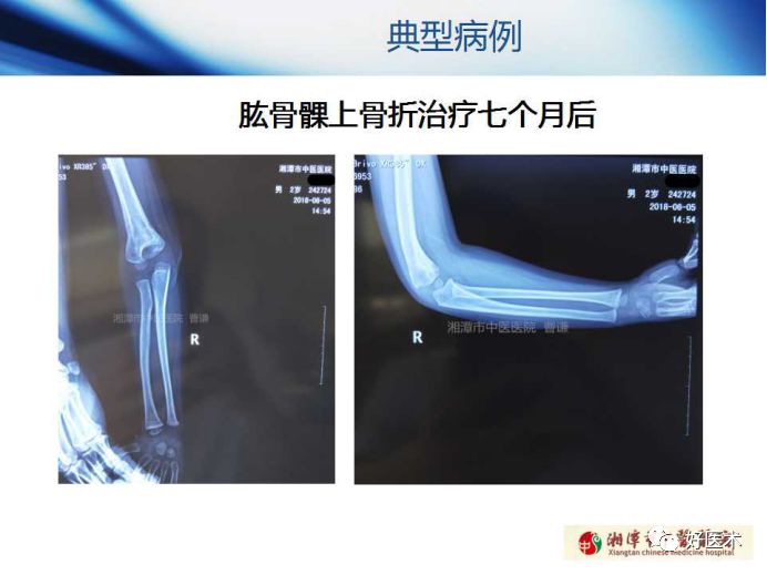 关于骨折塑形，这篇文章讲得太全面了！