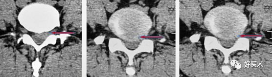 椎间孔镜治疗腰椎间盘突出症，技巧详解！