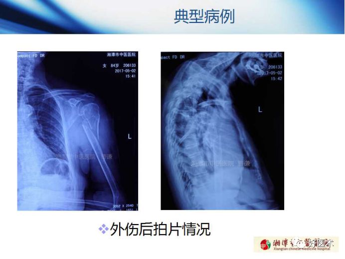 关于骨折塑形，这篇文章讲得太全面了！