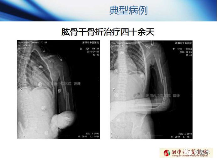 关于骨折塑形，这篇文章讲得太全面了！