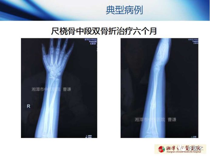 关于骨折塑形，这篇文章讲得太全面了！