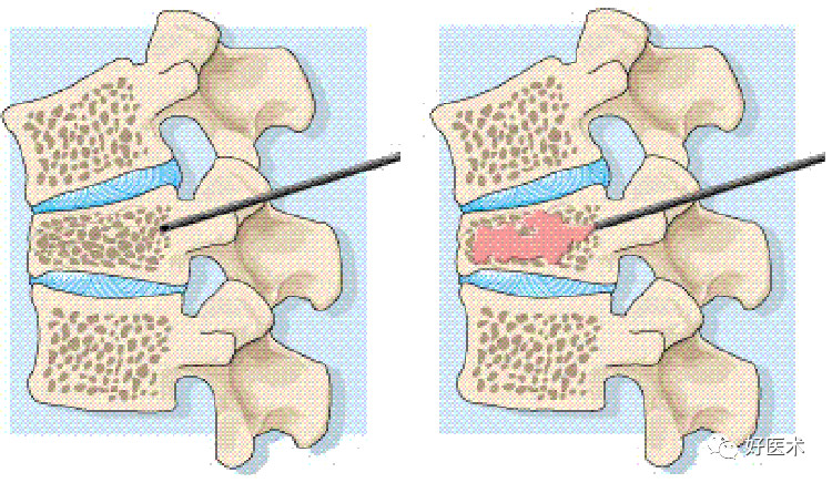 迟发性创伤后椎体塌陷，看看你到底了解了多少？